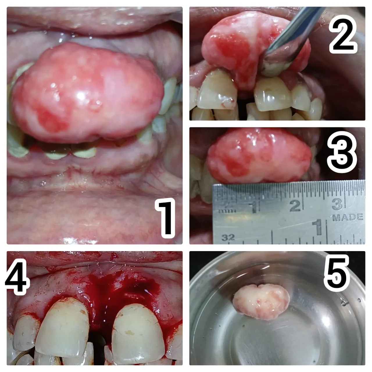 Surgical Epulis Excision (2cm) - Before & After Dental Treatment