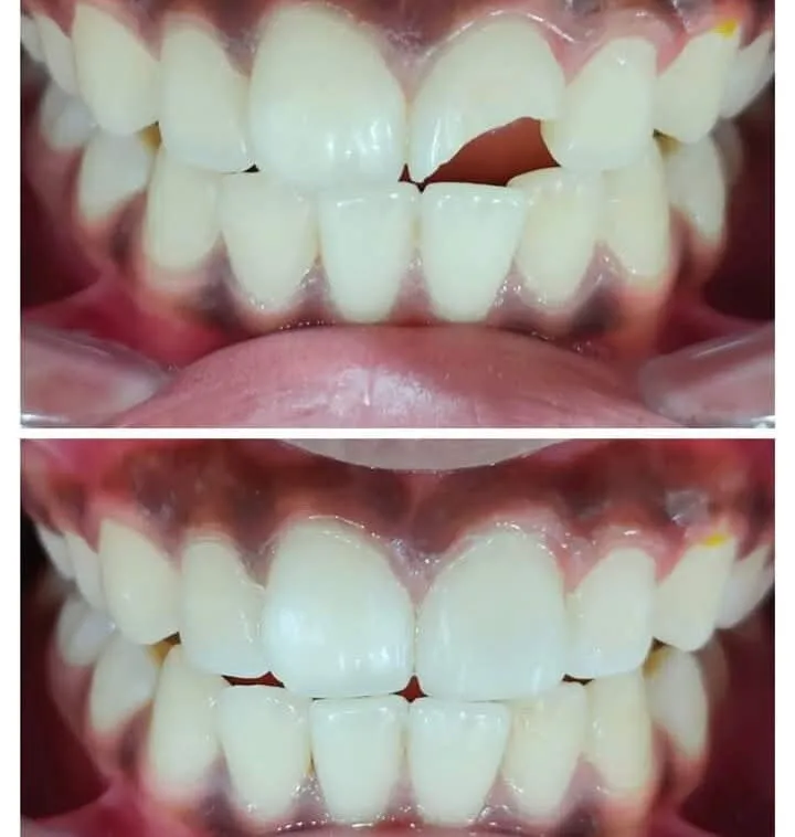 Anterior Crowding Correction - Before & After Dental Treatment