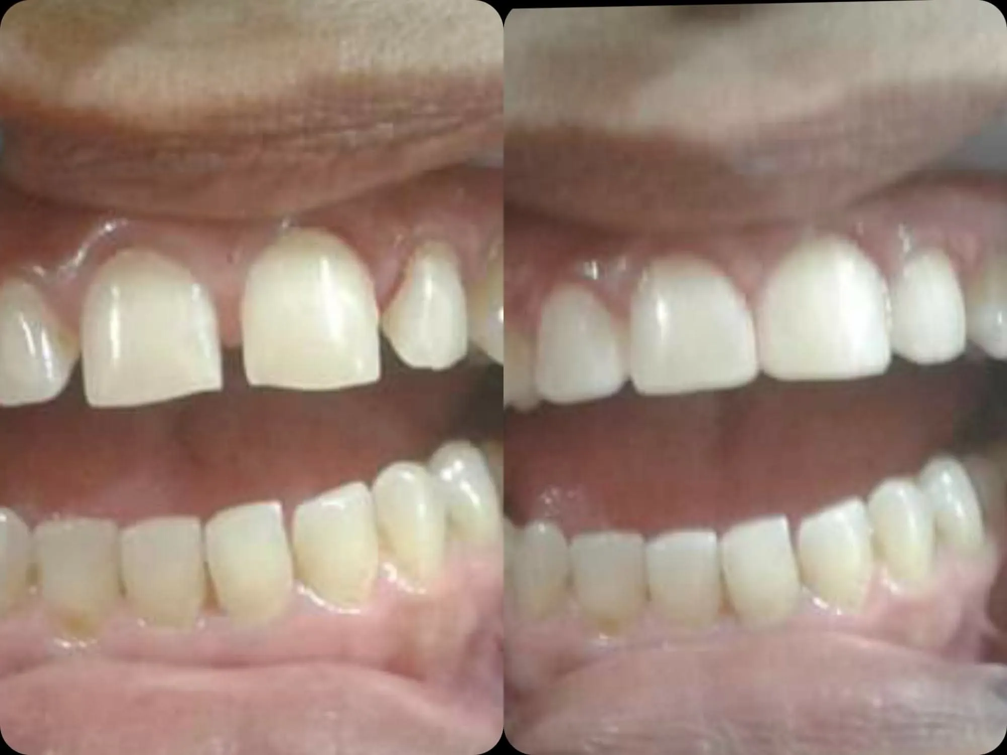 Diastema Closure Makeover - Before & After Dental Treatment