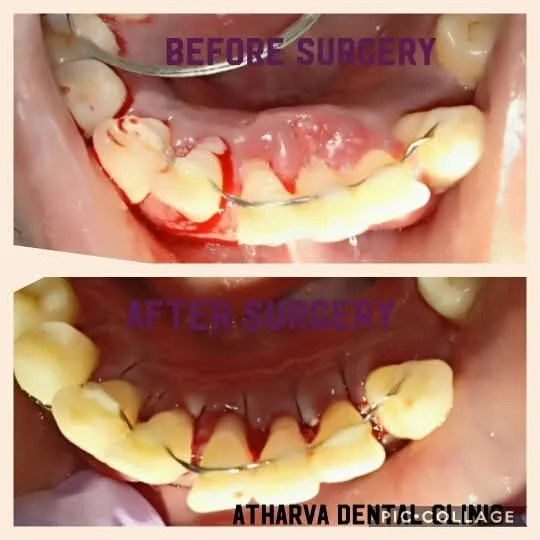 Surgical Exposures and Suturing - Before & After Dental Treatment