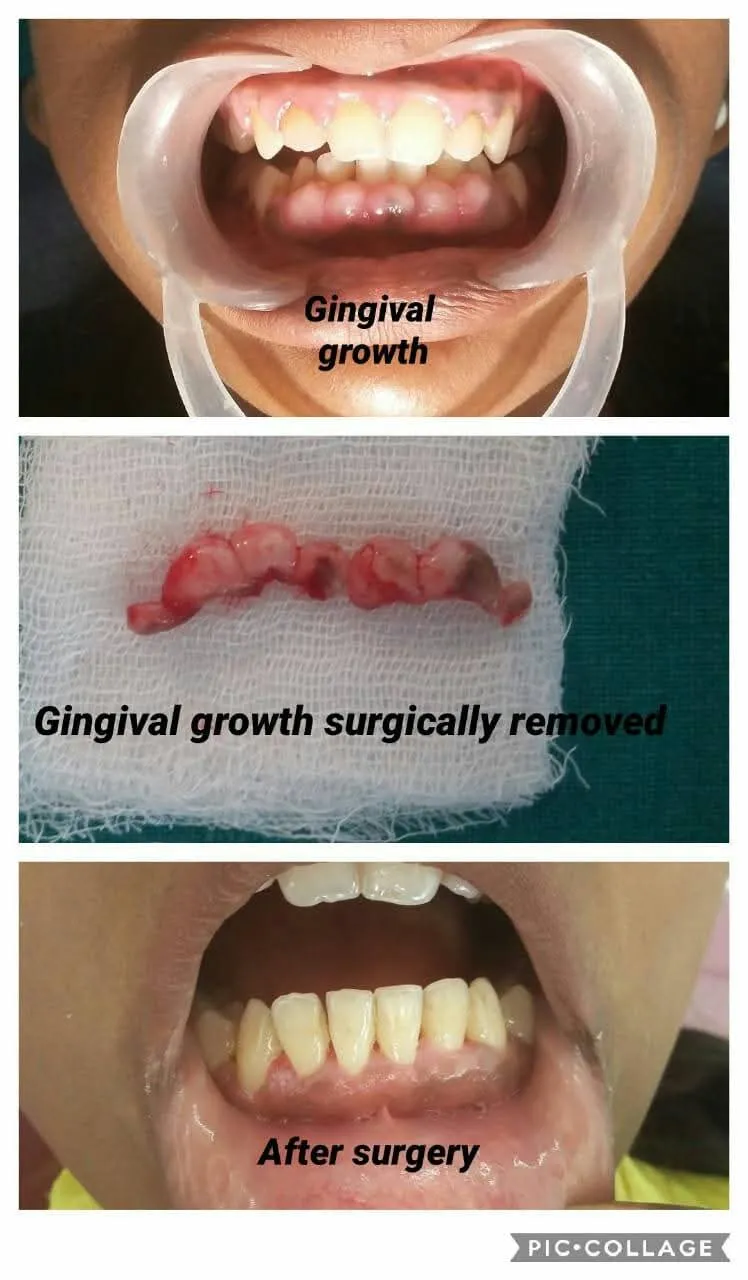 Gingival Hyperplasia Gum Excision - Before & After Dental Treatment